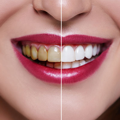 Estetica Dentale